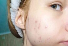 Безуспішна боротьба з акне. Рецидив