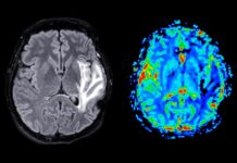 Menopauza a změny mozku: Omezený účinek HRT