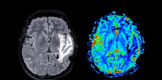 Менопауза та зміни мозку: обмежений вплив ЗГТ
