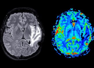 Menopause Terkait dengan Perubahan Otak, Tapi HRT Menunjukkan Dampak Terbatas