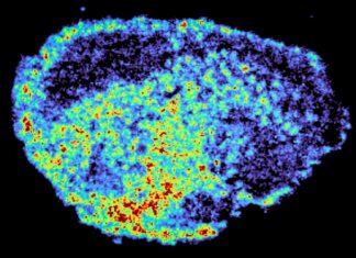 Mengapa Beberapa Obat Kanker Gagal: Distribusi Obat yang Tidak Merata di Dalam Tumor